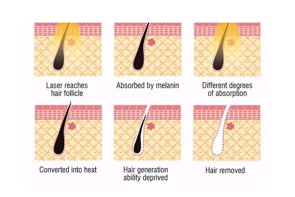 Konmison 5 Million Shots 808nm Diode Laser Hair Removal Machine