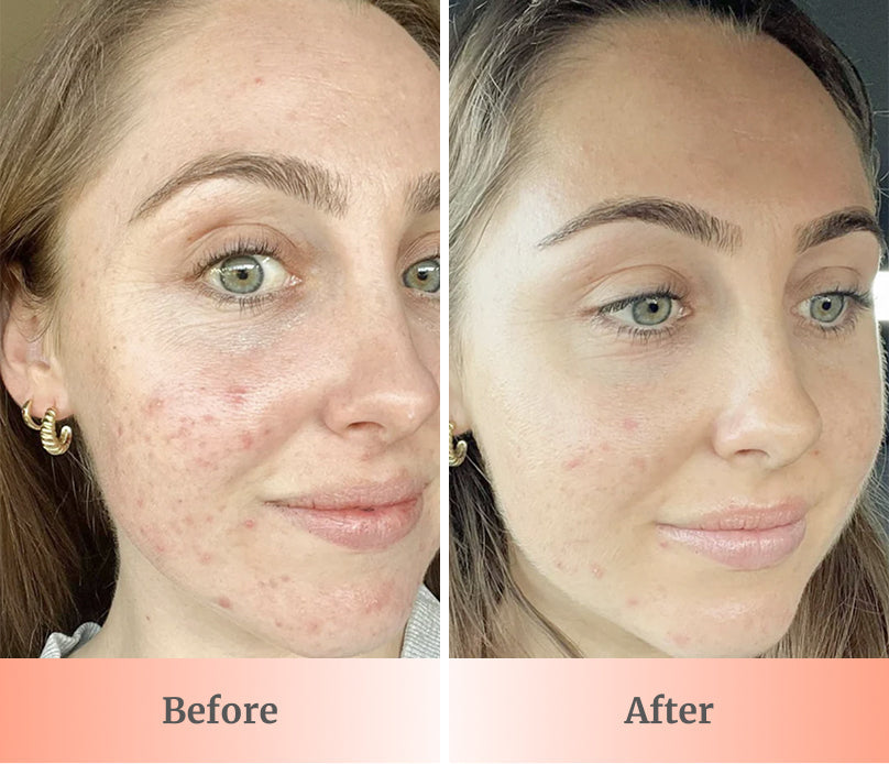 Groomie Hers Hollywood GlowUp™ LED Light Face Mask Deluxe Bundle