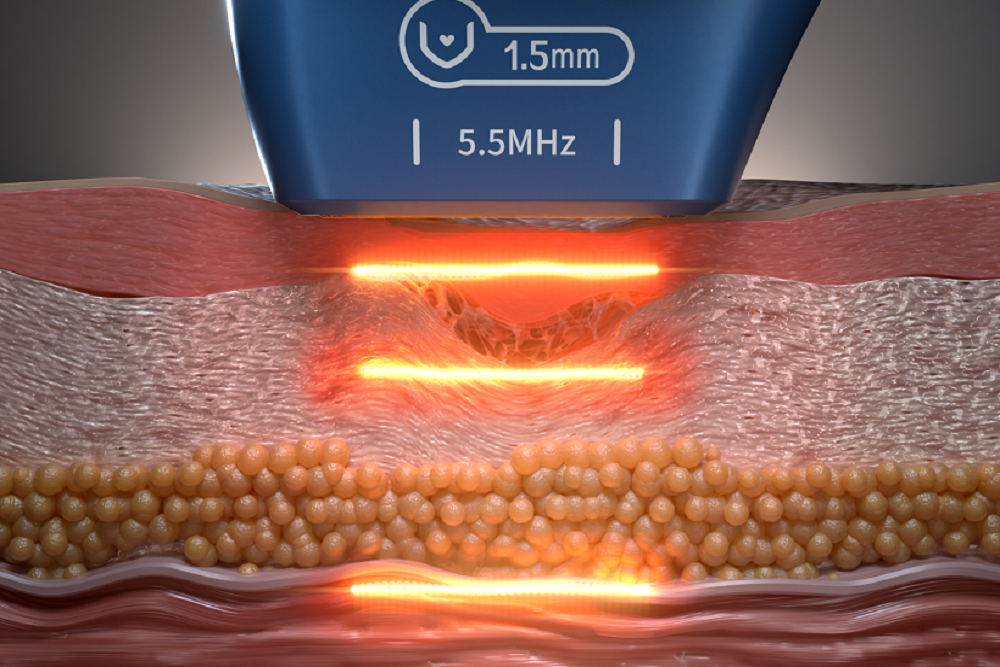 Konmison 3-in-1 Micro Pulse Ultrasonic Lifting & Skin Toning System