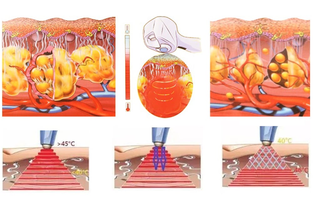 Konmison Exili Ultra 2-in-1 Ultrasound & RF Aesthetic Machine