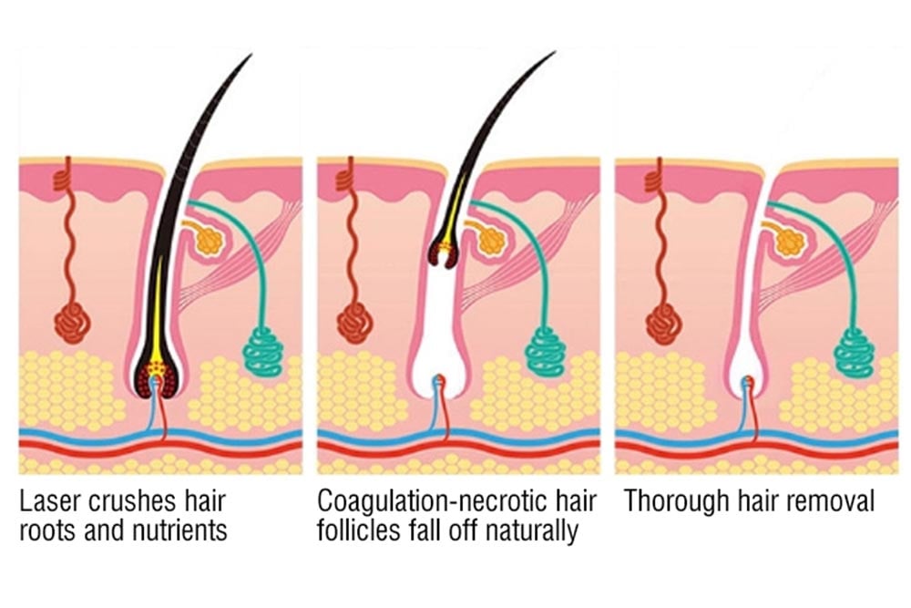 Konmison 5 Million Shots 808nm Diode Laser Hair Removal Machine