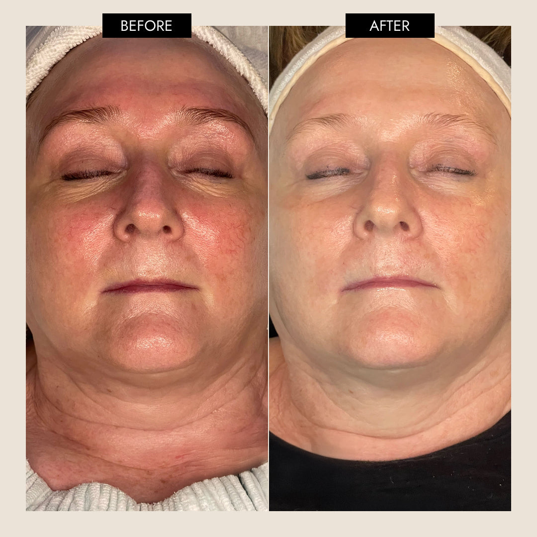 7E Wellness MyoLift Triwave Microcurrent Device