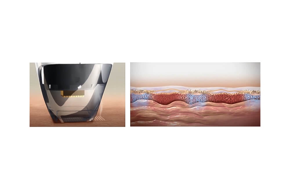 Konmison Portable Fractional RF Microneedling Machine