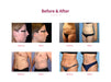 Shape Tactics 5-in-1 Cryolipolysis Vacuum RF Cooling System Cavitation Machines
