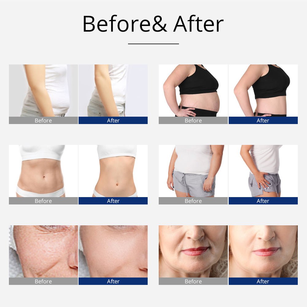 Shape Tactics 5-in-1 Unoisetion Cavitation 2.0 3D Smart Vacuum RF System Cavitation Machines