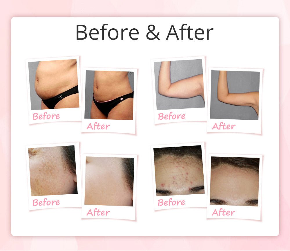 Shape Tactics 9-in-1 Unoisetion Cavitation RF Vacuum Bio Photon System Cavitation Machines