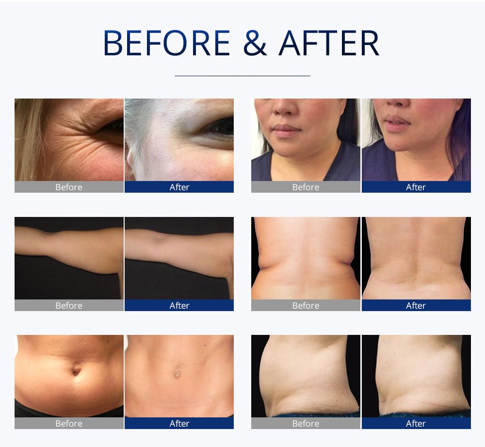 Shape Tactics S-Shape Pro 30K Cavitation RF Contouring System Cavitation Machines