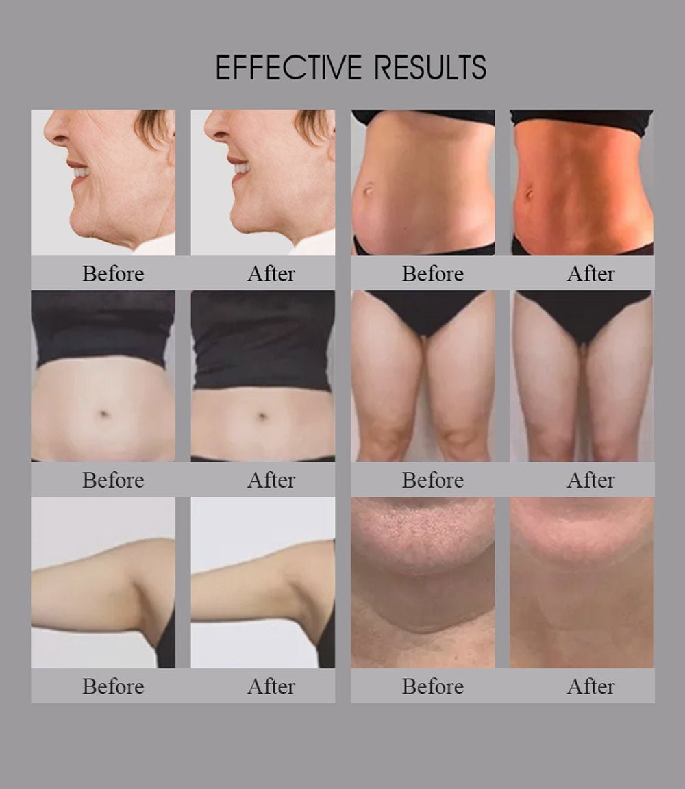 Shape Tactics Smart RF Body Contouring and Skin Rejuvenation System